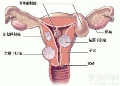 子宫切除后如何保养 子宫切除后怎样后期保养