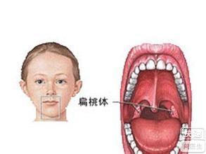 扁桃体化脓发烧反复 扁桃体炎为什么会发烧