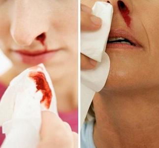 突然流鼻血的原因 什么原因导致流鼻血