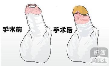 包皮过长自己矫正图 男性包皮过长怎么治疗