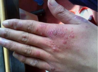 夏季湿疹的治疗方法 夏季湿疹怎么办 夏季湿疹的治疗方法
