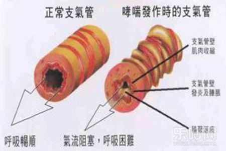 哮喘的最佳治疗方法 什么方法可以治疗哮喘