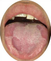 治疗舌炎的最好偏方 舌炎的症状及治疗方法