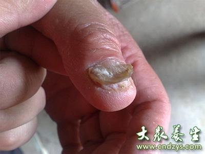 灰指甲有什么治疗方法 什么是灰指甲 灰指甲的治疗方法