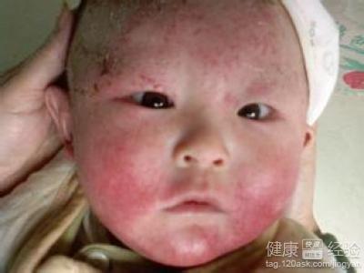 新生儿湿疹注意事项 宝宝湿疹要注意什么 新生儿湿疹是什么原因
