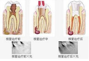 牙齿根尖炎能自愈吗 牙齿根尖炎怎么治疗