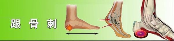 足跟骨刺的症状 足跟骨刺是怎么形成的