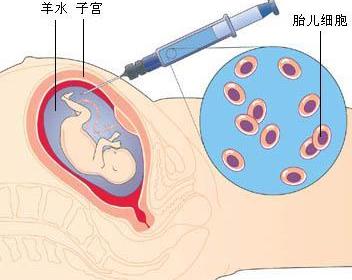 羊水栓塞 孕期谨防羊水栓塞