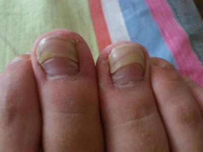 灰指甲不治疗的后果 灰指甲怎么回事