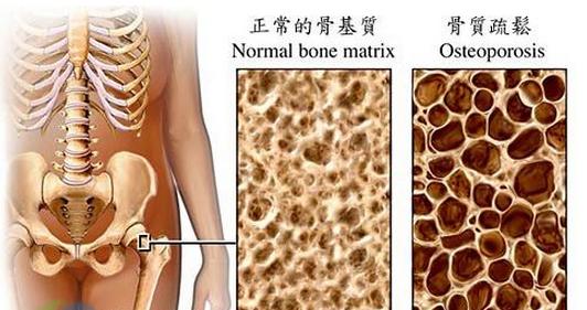 骨质疏松的治疗方法 骨质疏松最有效的治疗方法