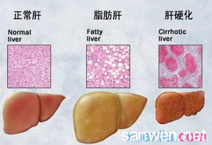 肝硬化病人的食物禁忌 肝硬化吃什么好_肝硬化病人宜吃的食物