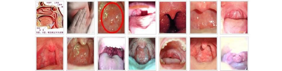 咽炎形成的症状 咽炎是怎样形成的 咽炎有什么症状