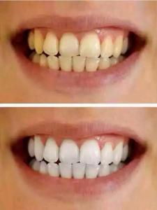 牙黄变白的简单方法 牙齿黄怎么办