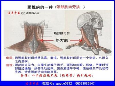 颈椎病治疗最佳方法 什么方法治疗颈椎病