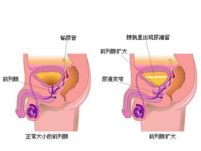 前列腺贴哪个牌子好 治疗前列腺炎有哪些方法