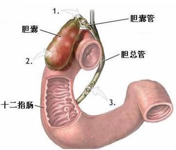 胆囊癌怎么检查出来 胆囊癌的病因