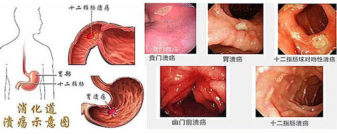 胃溃疡是怎么形成的 胃溃疡怎么形成的 胃溃疡检查和治疗
