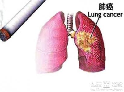 肺癌晚期姑息疗法 肺癌晚期的中药疗法有哪些