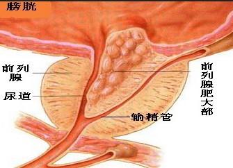 前列腺肥大症状及原因 前列腺肥大的原因与症状