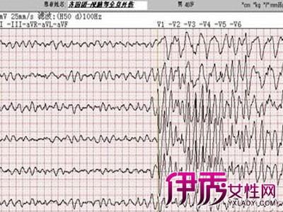 室颤的原因 室颤的原因有哪些