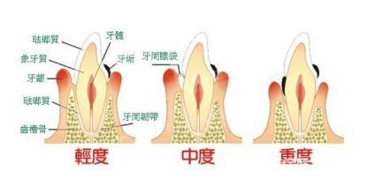 牙周炎怎么形成的 牙周炎形成的原因