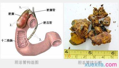 胆管结石最佳治疗方法 胆管结石是怎么形成的