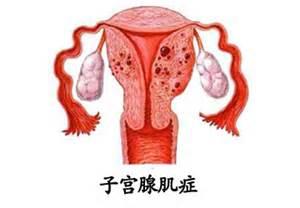 患有子宫腺肌症严重吗 患上子宫腺肌症的原因及治疗