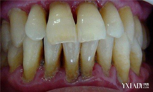 牙结石是怎么形成的 牙结石怎么形成的 牙结石治疗与防护