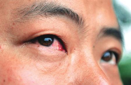 红眼病用什么眼药水好 红眼病的症状及治疗方法