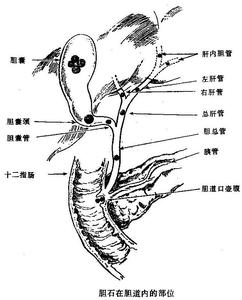 胆石症有哪些临床表现 胆石症的临床表现