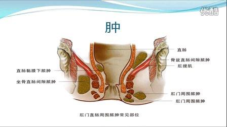 内痔会自愈吗 内痔疮的最佳治疗方法