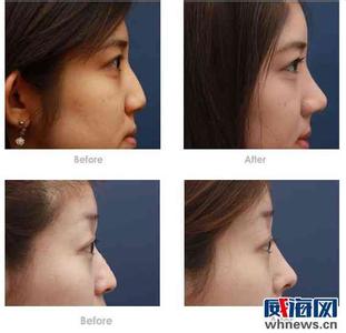 隆鼻术手术方法 什么是隆鼻术 隆鼻的方法