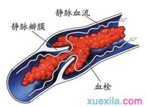 血栓形成的原因 血栓是怎样形成 血栓的形成原因