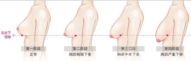 断奶如何防止乳房下垂 如何防止乳房下垂