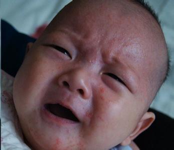 新生儿湿疹 新生儿宝宝患湿疹怎么办 婴儿湿疹正确处理方法