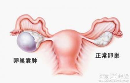 卵巢囊肿病因及治疗 卵巢囊肿形成的病因 卵巢囊肿如何治疗