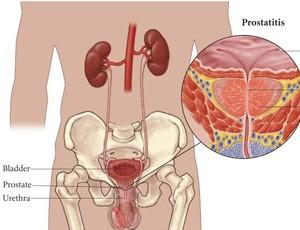 前列腺囊肿是什么症状 前列腺囊肿都的症状是什么