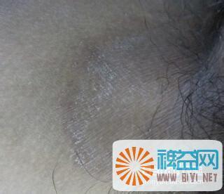 大腿内侧黑色素沉淀 大腿内侧发黑怎么一回事