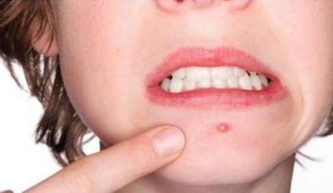 长痘痘的位置图解 唇周围长痘痘是什么原因