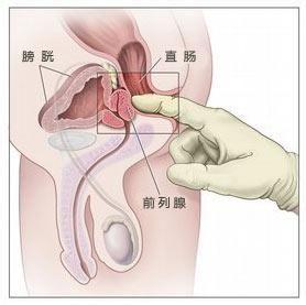 前列腺肥大的自我疗法 前列腺肥大有什么危害