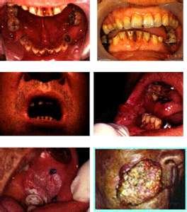 吃槟榔口腔癌图片 吃槟榔的容易得口腔癌