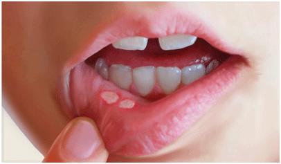 宝宝口腔溃疡最快方法 幼儿口腔溃疡的治疗方法