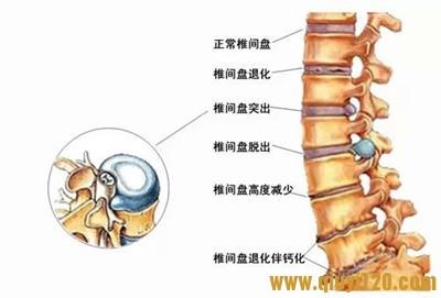 腰间盘突出的治疗方法 女人腰间盘突出的治疗方法