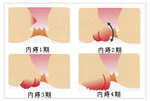 内痔脱出保守治疗 怎样治疗内痔脱出