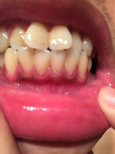 白血病牙齿出血图片 牙齿出血是白血病吗
