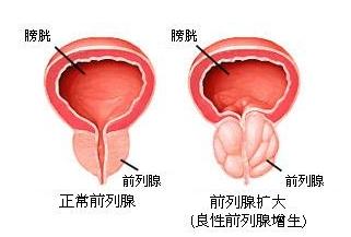 前列腺增生的治疗方法 前列腺增生的调理方法