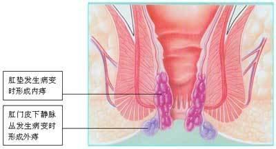 引起痔疮的原因有哪些 引起痔疮的原因是哪些