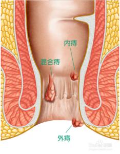 外痔疮消肿的最快方法 外痔疮怎么治疗