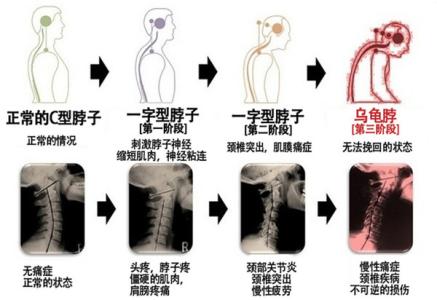 颈椎病的保守治疗方法 颈椎病最好的保守治疗方法