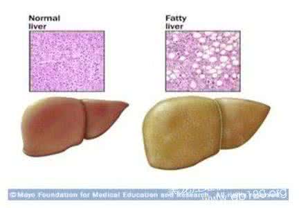 非均匀性脂肪肝 不均匀性脂肪肝的原因